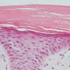 image03 Dry Thick Corneum Layer